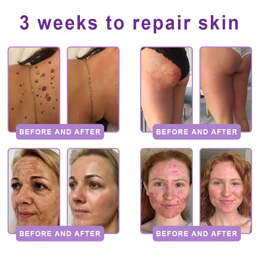 Certified: HISKIN® PDRN Multi-Peptide Massaging Body Roller Cream- Anti-aging, Hydrating, Skin Firming & Lifting, Skin Repair, Even Tone, Acne and Dark Spot Treatment, Wart and Mole Removal, and Psoriasis Relief.