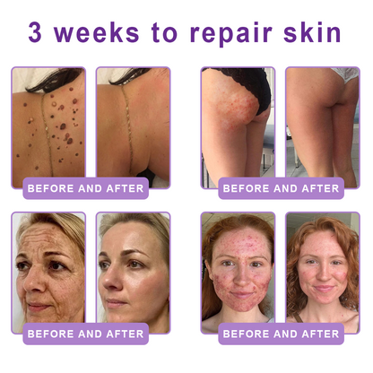 Certified: HISKIN® PDRN Multi-Peptide Massaging Body Roller Cream- Anti-aging, Hydrating, Skin Firming & Lifting, Skin Repair, Even Tone, Acne and Dark Spot Treatment, Wart and Mole Removal, and Psoriasis Relief.