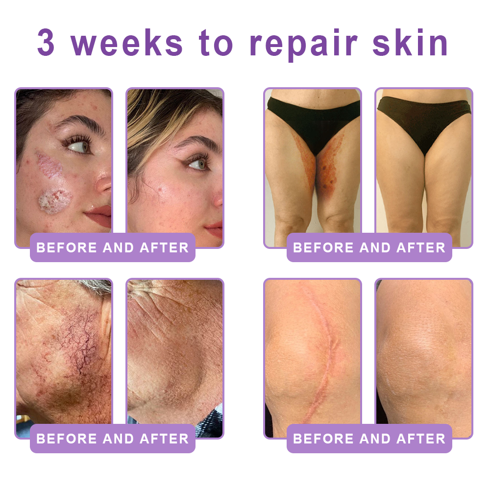 Certified: HISKIN® PDRN Multi-Peptide Massaging Body Roller Cream- Anti-aging, Hydrating, Skin Firming & Lifting, Skin Repair, Even Tone, Acne and Dark Spot Treatment, Wart and Mole Removal, and Psoriasis Relief.