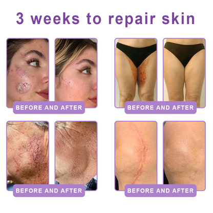 Certified: HISKIN® PDRN Multi-Peptide Massaging Body Roller Cream- Anti-aging, Hydrating, Skin Firming & Lifting, Skin Repair, Even Tone, Acne and Dark Spot Treatment, Wart and Mole Removal, and Psoriasis Relief.