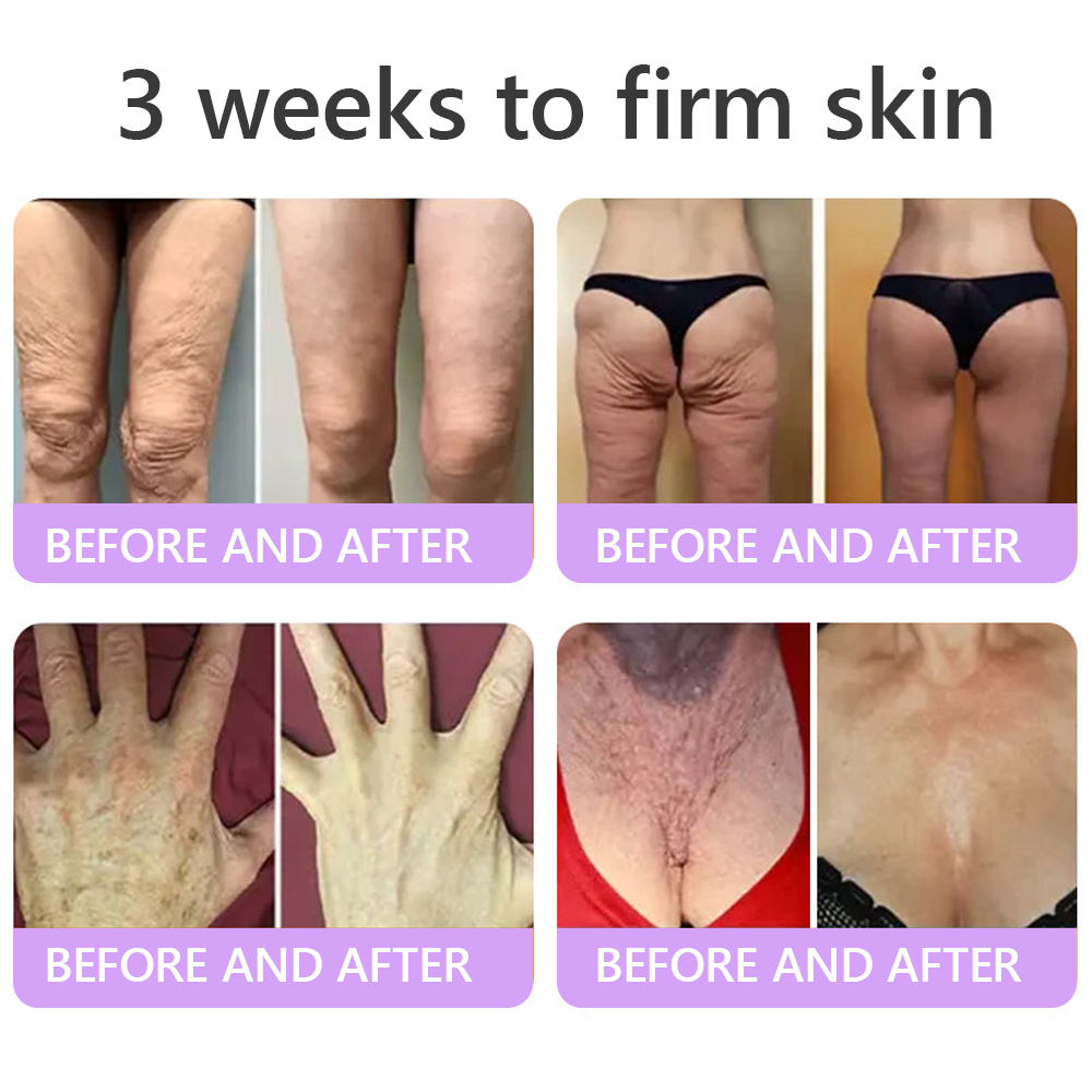 Certified: HISKIN® PDRN Multi-Peptide Massaging Body Roller Cream- Anti-aging, Hydrating, Skin Firming & Lifting, Skin Repair, Even Tone, Acne and Dark Spot Treatment, Wart and Mole Removal, and Psoriasis Relief.