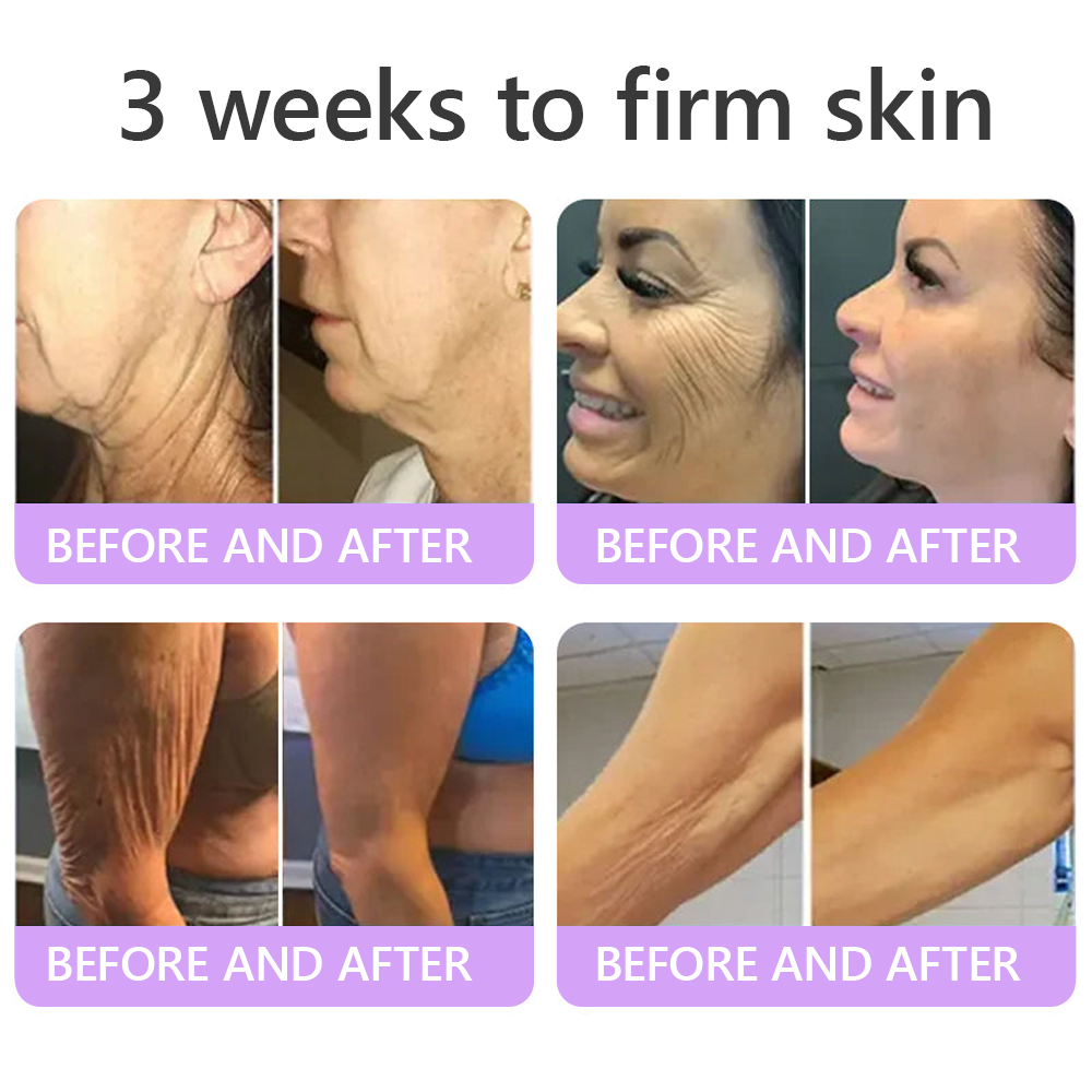 Certified: HISKIN® PDRN Multi-Peptide Massaging Body Roller Cream- Anti-aging, Hydrating, Skin Firming & Lifting, Skin Repair, Even Tone, Acne and Dark Spot Treatment, Wart and Mole Removal, and Psoriasis Relief.