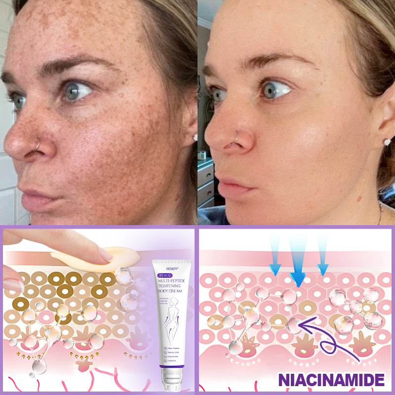 Certified: HISKIN® PDRN Multi-Peptide Massaging Body Roller Cream- Anti-aging, Hydrating, Skin Firming & Lifting, Skin Repair, Even Tone, Acne and Dark Spot Treatment, Wart and Mole Removal, and Psoriasis Relief.