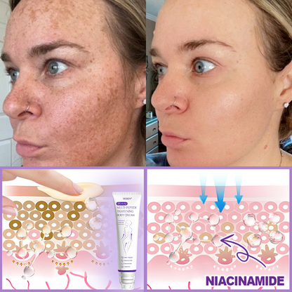 Certified: HISKIN® PDRN Multi-Peptide Massaging Body Roller Cream- Anti-aging, Hydrating, Skin Firming & Lifting, Skin Repair, Even Tone, Acne and Dark Spot Treatment, Wart and Mole Removal, and Psoriasis Relief.